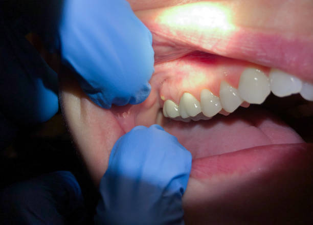 Best Root Canal Emergency Dentist  in Collins, MS